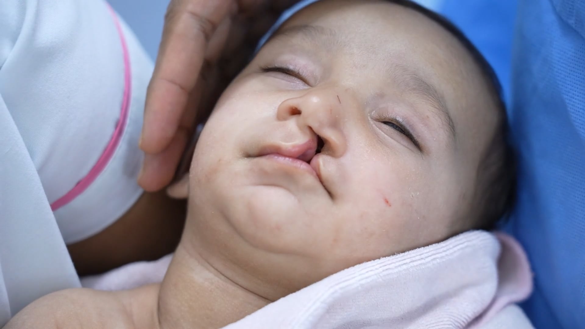 Cleft lip surgery for baby